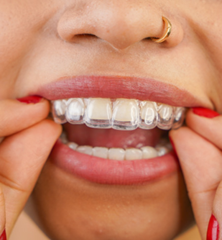 Closeup of patient putting on clear aligner