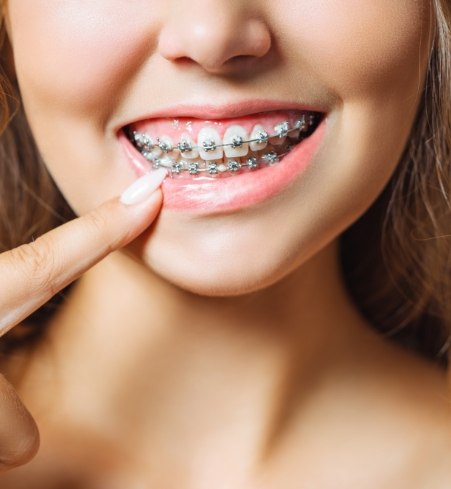 Closeup of smile with traditional braces