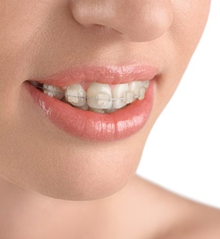 Closeup of smile with clear and ceramic braces