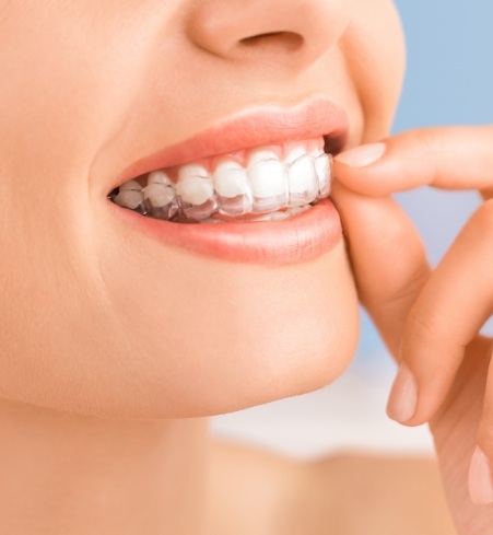 Closeup of patient placing Invisalign clear aligner