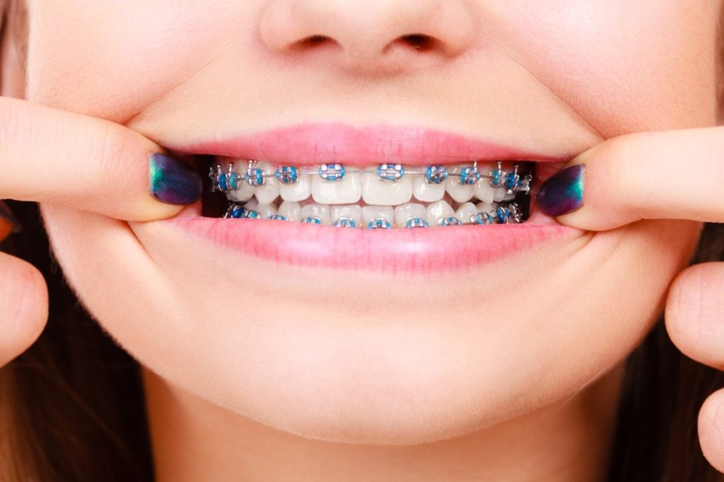 Patient showing her teeth with braces