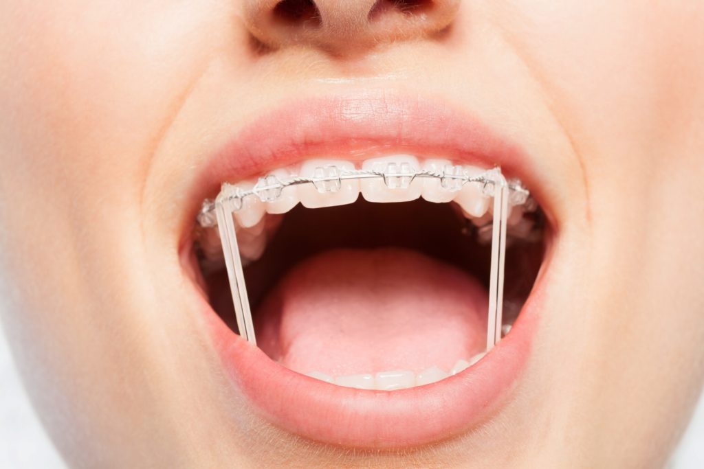 Closeup of woman with rubber bands on braces