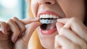 a patient holding their Invisalign tray